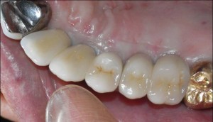 左奥歯インプラント2